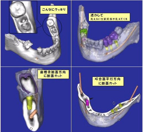 インプラント